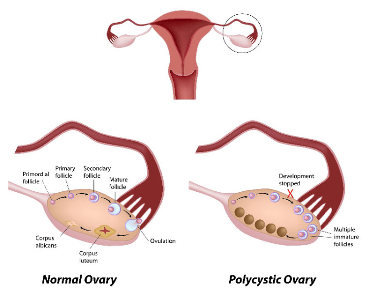Polycystic-Ovarian-Syndrome-Symptoms-750x600.jpg